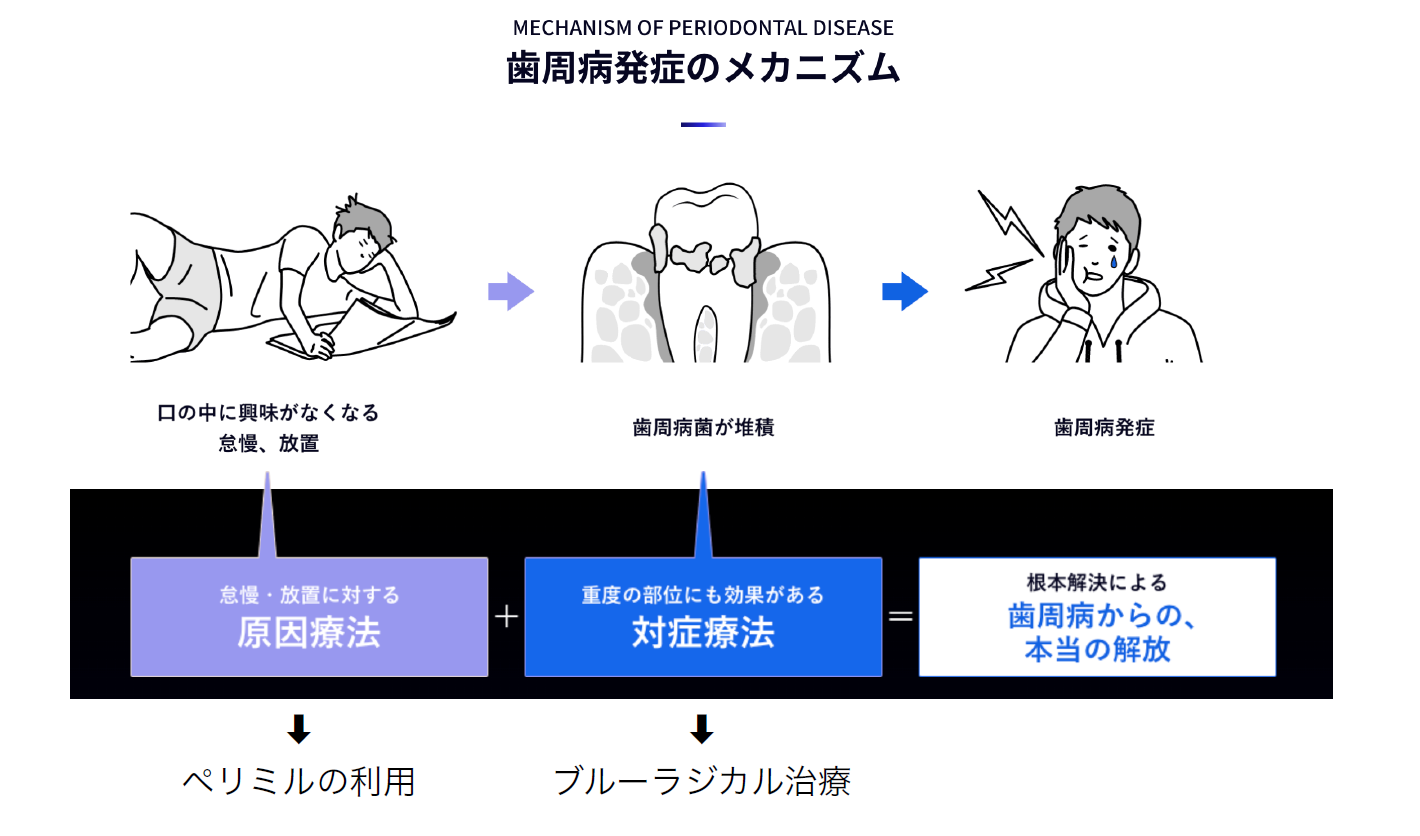 ペリミルとは？
